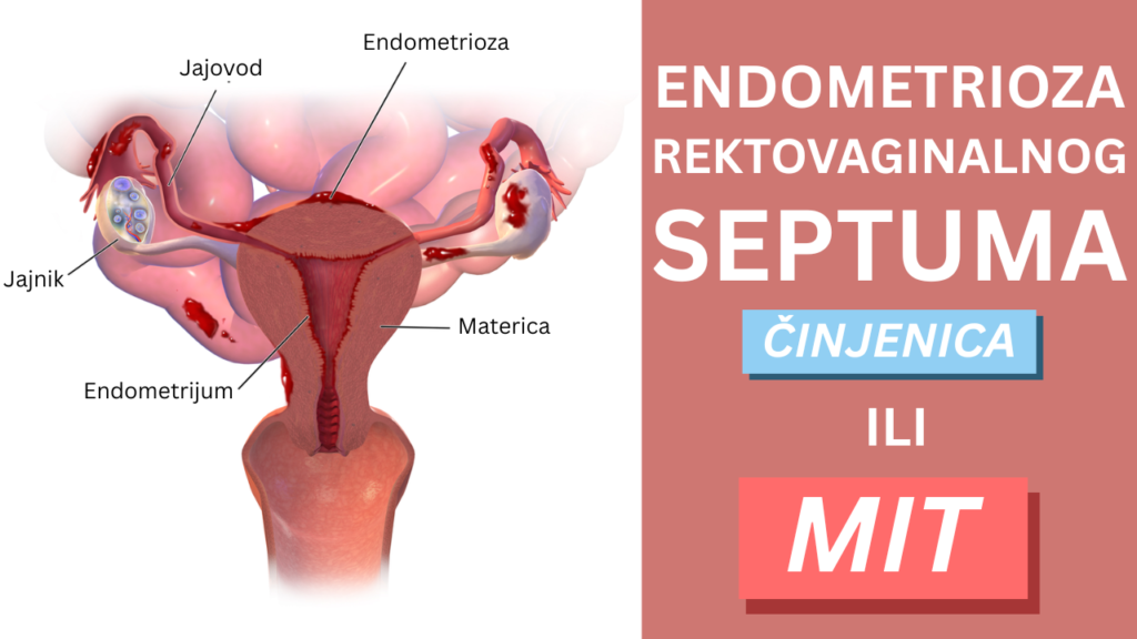 Medicinski mit star decenijama? Endometrioza rektovaginalnog septuma